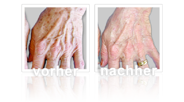 Altersflecken - Handrücken nach der 1. Behandlung