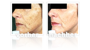 Pigmentflecken – Gesicht nach der 2. Behandlung